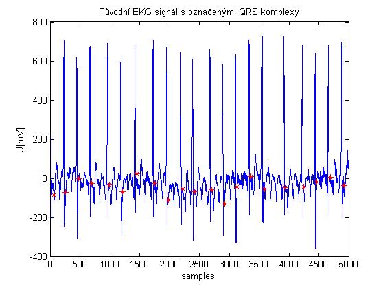5.6.3 Signál W111 Obrázek 5-16 zobrazuje EKG signál vyznačující se velkým počtem QRS komplexů.