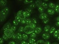 fluorescence jader a-jo-1 (histidyl trna syntetáza): jemně zrnitá fluorescence cytoplazmy s max.