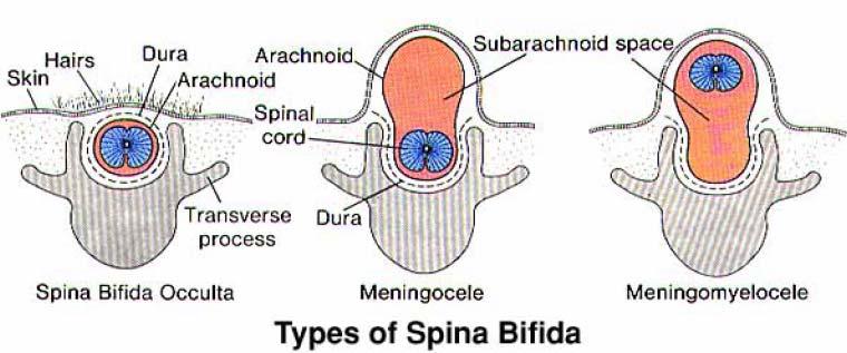 Spina bifida