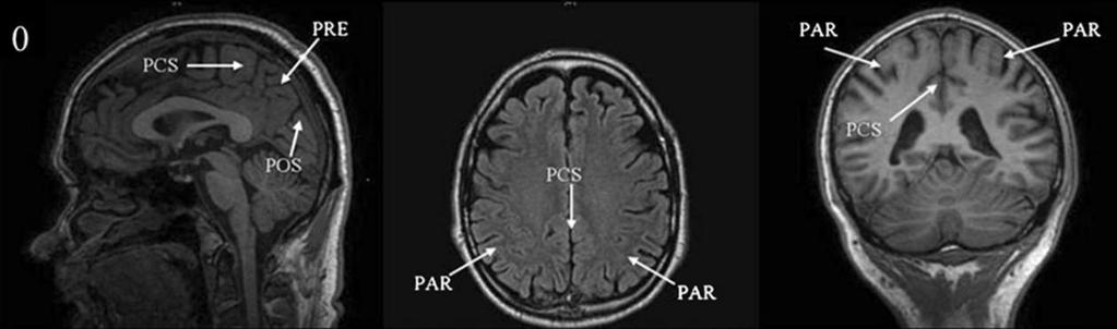 Koedamovo skore parietální atrofie Stupeň 0: Žádná atrofie Úzké sulci parietálního laloku a cuneu PCS