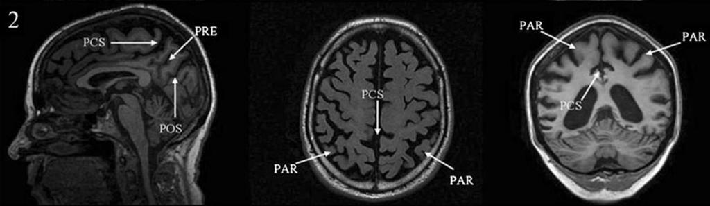 Koedamovo skore parietální atrofie Stupeň 2: Značná parietální atrofie Značně rozšířené sulci PCS