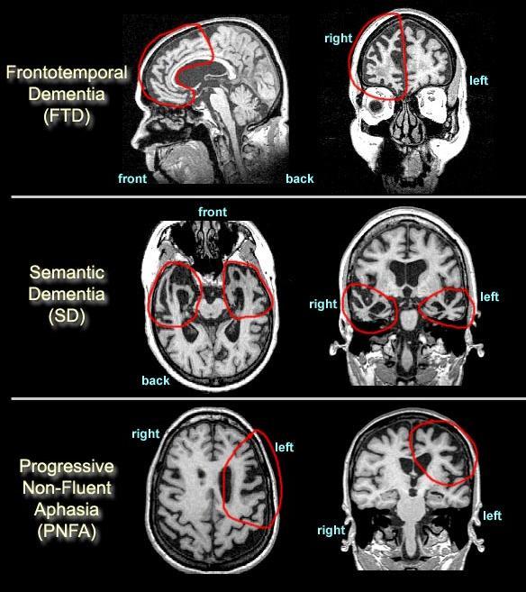 Klinický syndrom Frontotemporální demence, Pickova Frontální a temporální lalok bilat.