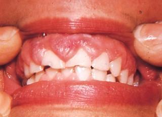 U obou těchto stavů dochází k opotřebení a tudíž i úbytku incizálních hran klinické korunky zubu, kdy se následně korunky jeví kratší.