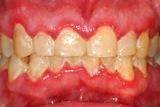 Nejčastější příčinou zmnožení tkáně dásní je však zubní plak. Obr. 12- zmnožení tkáně dásně způsobené zubním plakem Zdroj: http://www.lesbursteindds.