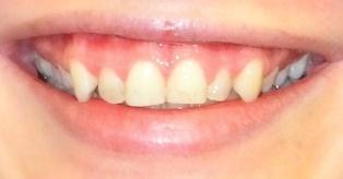 Dále uvádí, že gummy smile může působit rušivě na estetiku úsměvu podle míry odhalené dásně.