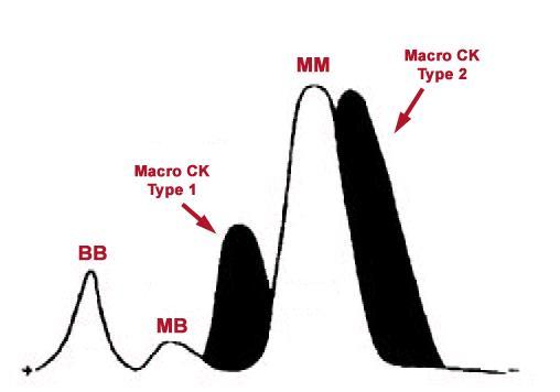 1970 s kreatinkináza (CK) -B (brain type) a M (muscle type) BIOMARKERY Markery poškození -isoenzymy: CK-BB