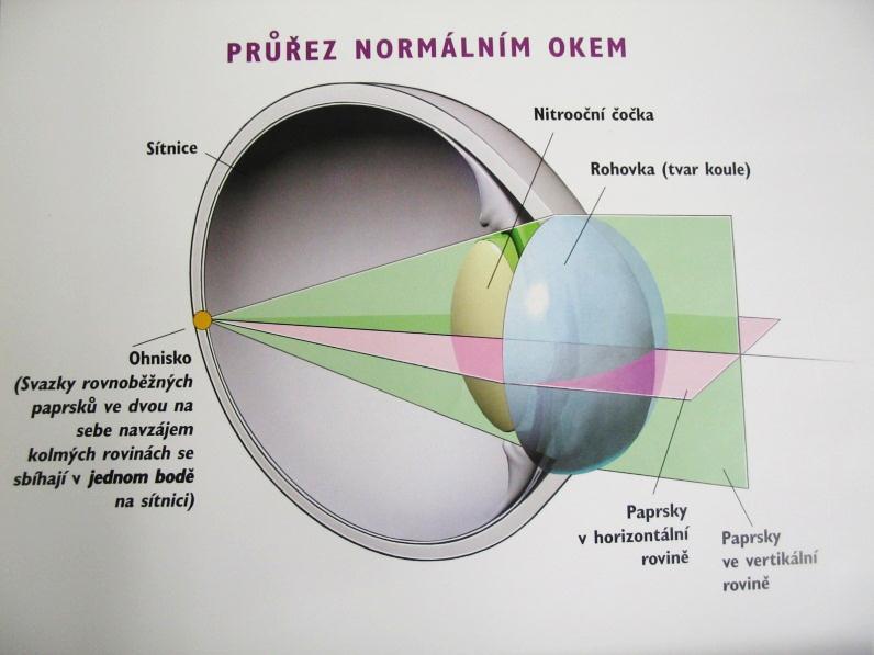 Astigmatická vada u oka Odstranění vady: Toroidní