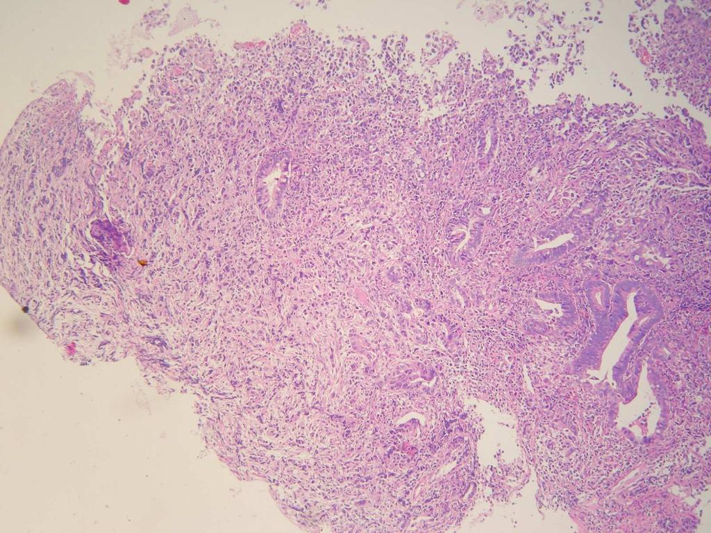 HE, 200x Obrázek 6 Histologický obraz karcinomu u nemocného s UC.