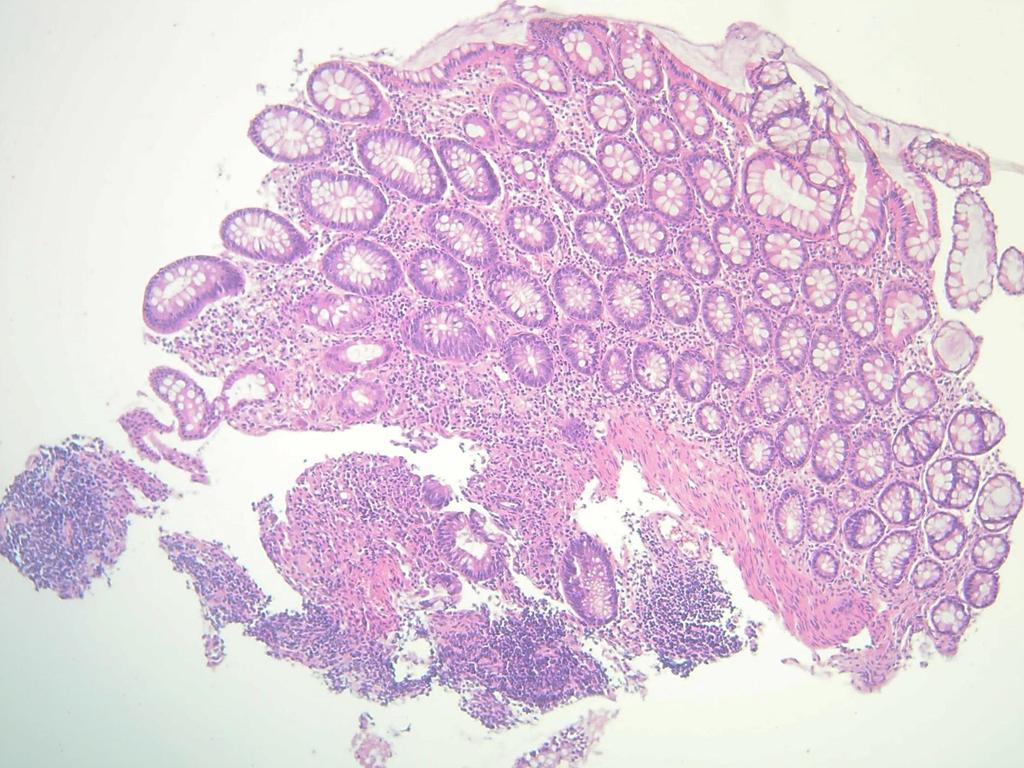 Etážová biopsie Terminální ileum Cékum