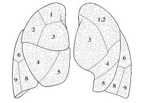 Obr. 2.2: Plicní laloky a segmenty. Převzato z [9] 2.3 Patologie plic způsobující nehomogenitu Plicních patologií způsobujících nehomogenitu je celá řada.