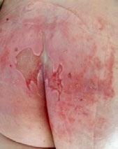 Kategorie 2: Ztráta kůže 2A - Ztráta kůže bez známek klinické infekce Ztráta kůže Ztráta kůže se může projevit jako eroze kůže (může být důsledkem poškozené, erodované kůže vezikul a bul/puchýřků)