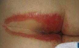 Příznaky infekce Jako např. bílá olupující se kůže (příznak plísňové/mykotické infekce) nebo satelitní (lokální) léze (pustuly v okolí lézí jsou známkou mykotické infekce způsobené Candida albicans).
