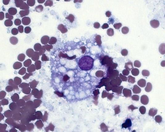Obr. 5: Erytrofág-čerstvě fagocytované i dekolorované erytrocyty v hrudním výpotku Obr.