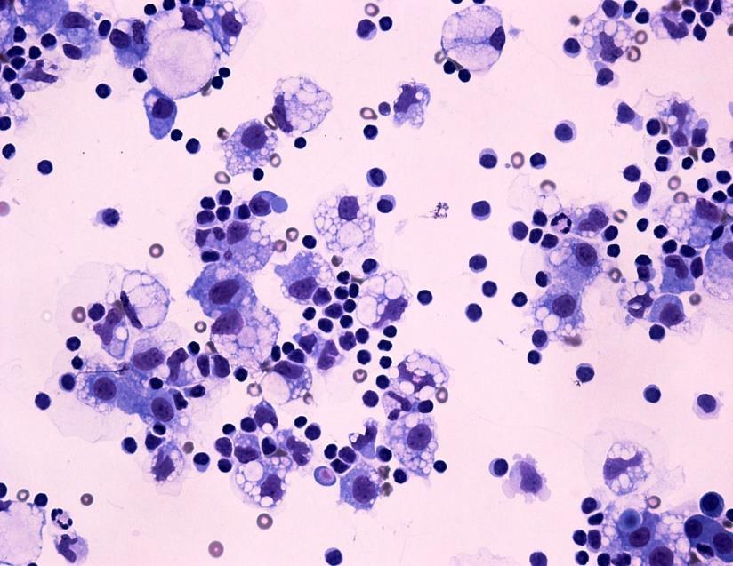 Obr. 12: Četné monocytárně-makrofagické elementy v hrudním výpotku 6.1.3 Neutrofilní granulocyty Neutrofilní granulocyty jsou buňky nespecifické imunity (Obr. 13).