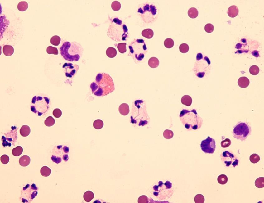 Obr. 13: Převaha neutrofilních granulocytů v hrudním výpotku 6.1.4 Eosinofilní granulocyty Eosinofilní granulocyty jsou rovněţ buňky nespecifické imunity (Obr. 14).