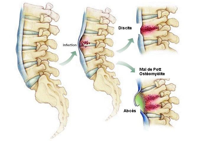 Vývoj hnisavých onemocnění páteře www.