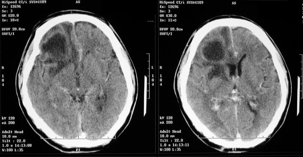 Mozkový absces http://www.aic.cuhk.edu.