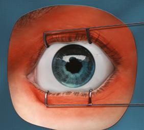 Vyhněte se nadměrnému tlaku na oční žlázy. 3,5 4,0 mm 4.