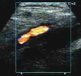 sonografie dopplerovské vyšetření