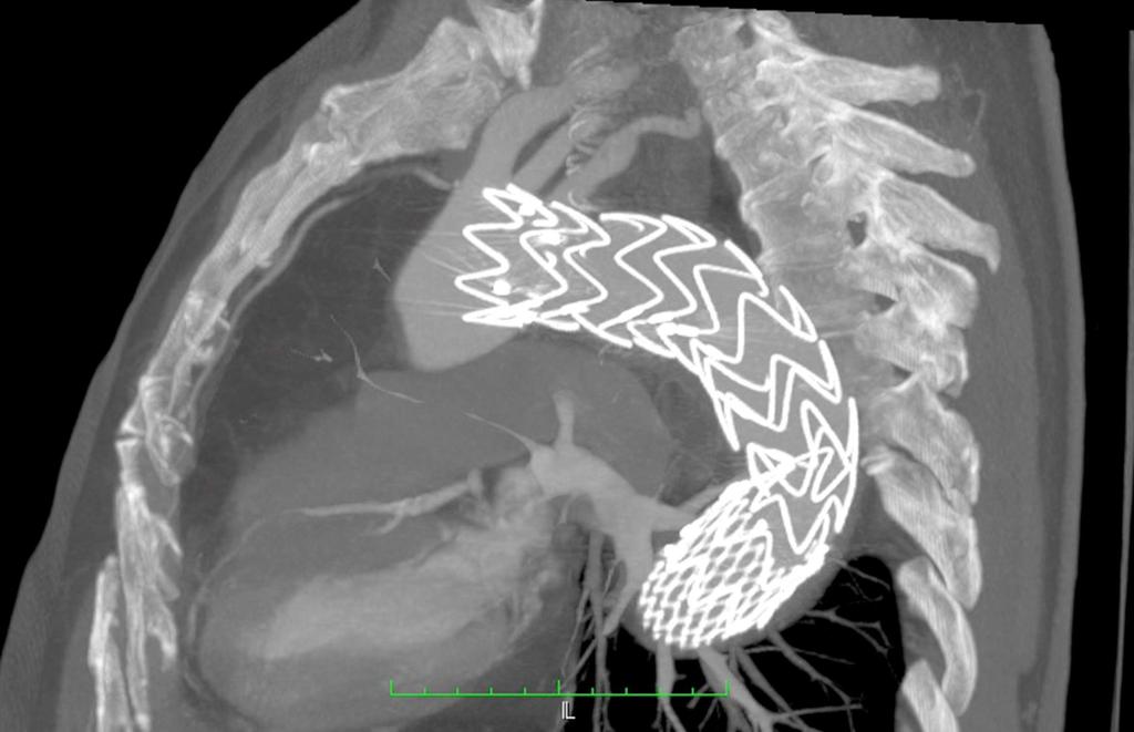 (TAVI TF/TA), stentgraft MAZE