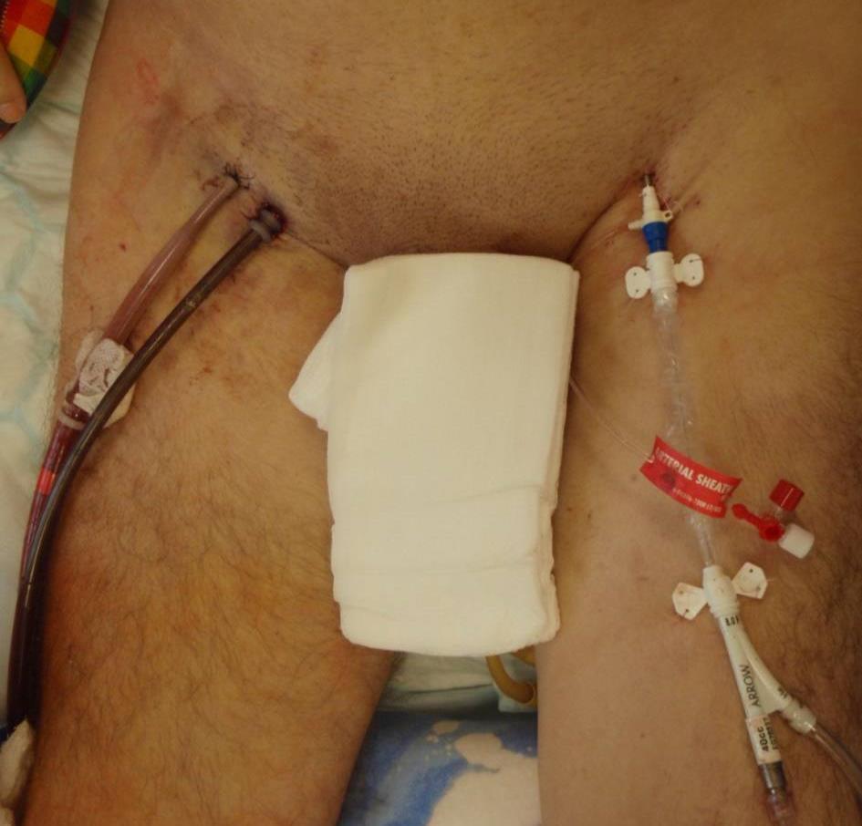 Peripheral ECMO V-A Femoro-femoral O 2 pump IVC oxygenator Fem. Art.