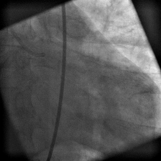 Bolest na hrudi, AIM přední stěny, TK 70/50 mmhg, 1x
