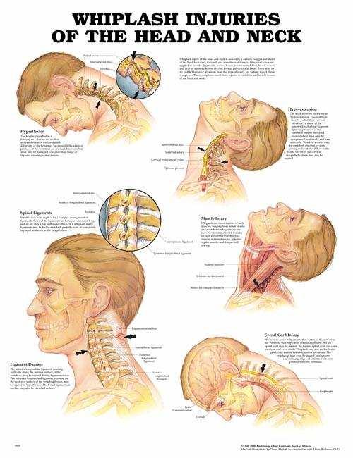 Obrázek 2. Whiplash poranění (http://www.
