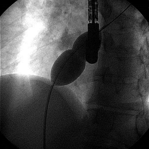 Katetrizační uzávěr defektu septa síní Posouzení anatomie při TEE Lokalizace a