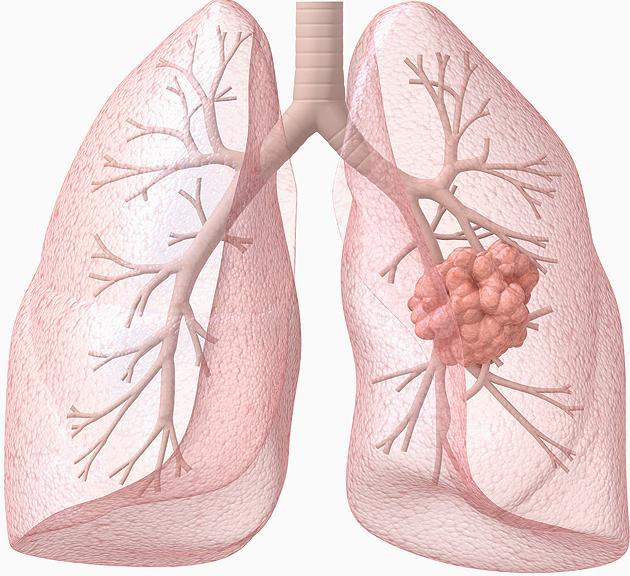 dva typy: nemalobuněčný typ, který představuje přibližně 80 % případů rakoviny plic, a malobuněčný typ (asi 17 %), který se v drtivé většině vyskytuje u kuřáků.