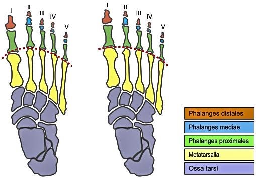 3 MORTONOVA NOHA Mortonova noha, dále MN, je běžná porucha přednoží, při které je druhý metatarz delší než první (obr. 3). (Rothbart, 2002) Obrázek 3: Mortonova noha (vlevo) - tzv.