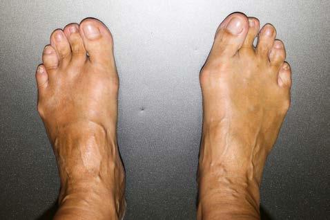 Obrázek 14: Fotografie nohou sledovaného subjektu + plantografický snímek; zdroj: vlastní P noha: MN 10 mm, NDT 8 mm L noha: MN 9 mm, NDT 2 mm Ačkoliv je na P noze HV deformita výrazně více vyjádřena