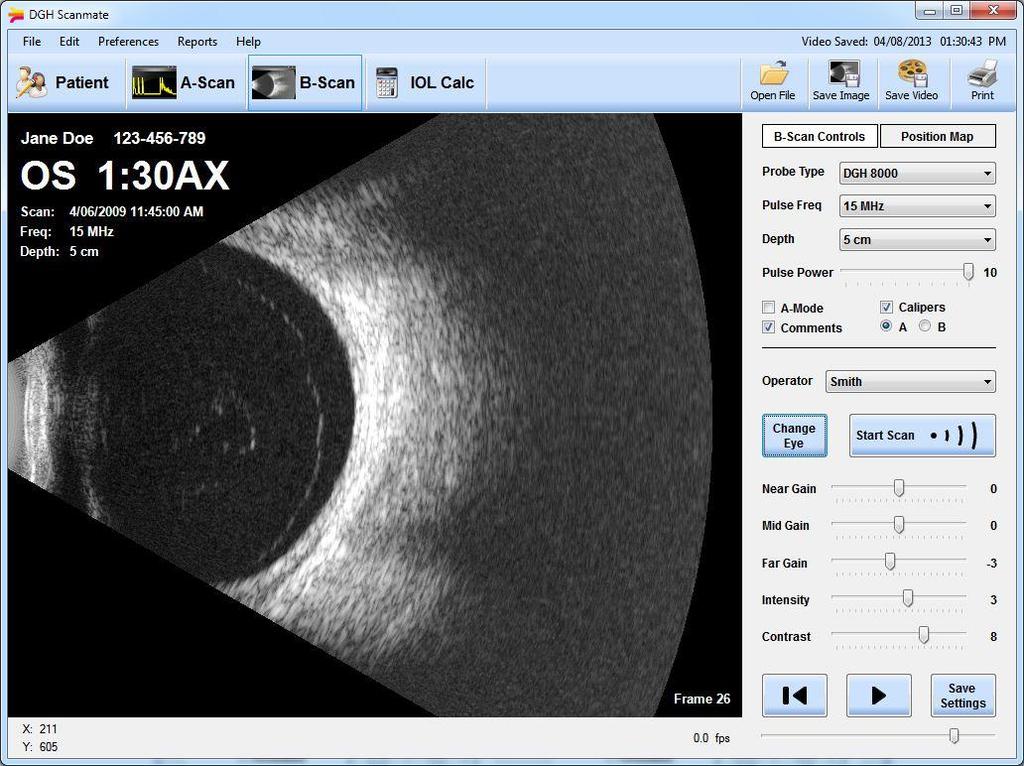 16 Okno B-skenu (B-Scan Screen) Okno B-skenu umožňuje uživatelům provádět a prohlížet měření B-skenů u aktuálně zvoleného pacienta.