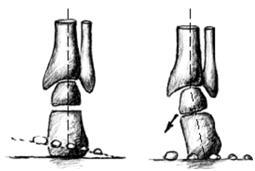 Kloub subtalární se tak ve stoji kompenzačně stáčí navnitř k docílení kontaktu přednoží s podložkou. valgózní přednoží patní kost je v rovině, ale přednoží je vytočeno malíčkem vzhůru, Obr. 4.