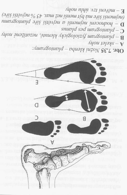 - nesprávná obuv vysoké podpadky nad 5 cm s častým nošením, úzká špička, pasivní nevhodné podpory a podpěry etc.