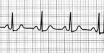 Určení srdeční frekvence: - R-R - 4