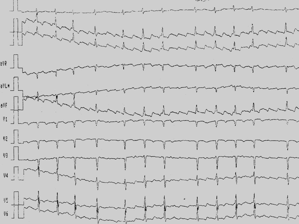 EKG 3