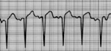 Určení srdeční frekvence: - EKG pravítko - Dle počtu velkých čtverců - Spočteme množství velkých čtverců mezi R R kmity.