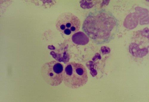 Obrázek 8: Degenerativní formy neutrofilů 14. PATOLOGICKÉ CYTOLOGICKÉ NÁLEZY V LIKVORU Známky nespecifické aktivace v cytologickém obraze: Příčiny např.