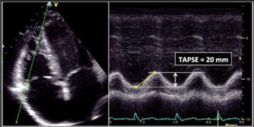 Globální systolická funkce PK EF PK se rutinně nekalkuluje (pouze 3D ECHO) TAPSE (Tricuspid Annular Plane Systolic Excursion) M-mode s kurzorem umístěným na lat.