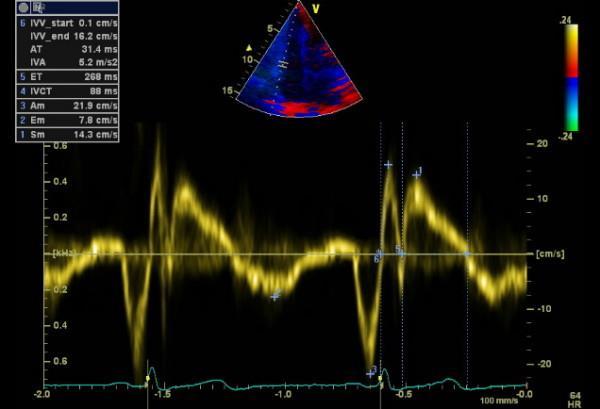 Globální systolická funkce PK S vlna na tkáňovém doppleru Norma 9,5 cm/s AP4C, kurzor pulsního doppleru umístěný