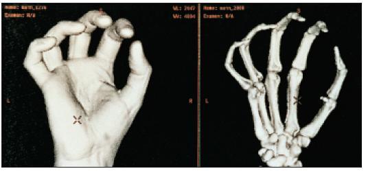 RADIOGRAFIE A RADIOTERAPIE V LÉKAŘSTVÍ Lékařská radiografie využívá schopnosti paprsků X procházet lidským tělem.