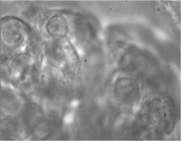 Obrázek 18 C Dlaždicobuněčná metaplazie nazálního epitelu šipka