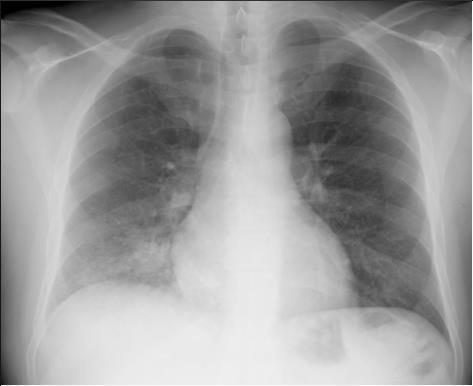 Obr. č. 2 RTG hrudníku Obr. č. 3 Spirometr Obr. č. 4: spirometrická křivka Obr. č. 2. Zdroj: Chronická obstrukční plicní nemoc (CHOPN)[obrázek]. In: Vitalia.cz [online]. 2011 [cit. 2018-04-11].