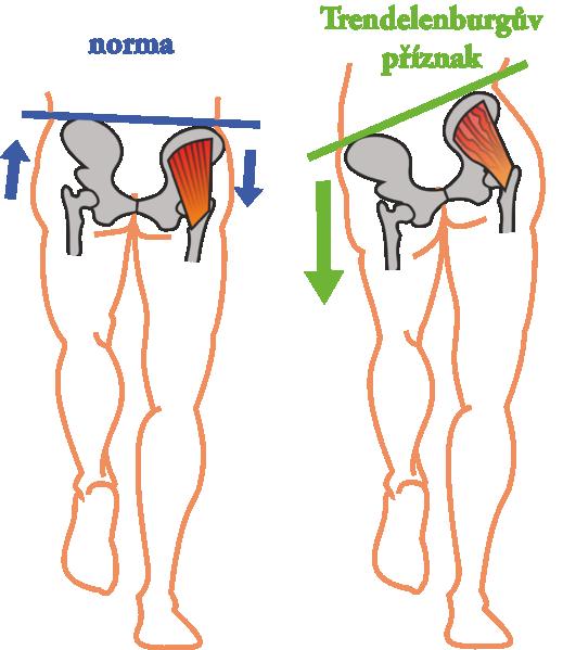 Obrázek 17: Postoj v normě a Trendelenburgův příznak Zdroj: http://www.wikiskripta.eu/index.php/soubor:trendelenburg-p%c5%99%c3%adznak.png [online]. [cit. 2017-04-