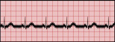 4 EKG signál rušení a srdeční arytmie Při snímání EKG signálu nikdy nedostaneme dokonale čistý signál bez rušení.