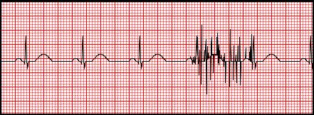 4.2.2 Myopotenciálové rušení Tento typ rušení je výrazně zastoupen při snímání zátěžového EKG a při snímání EKG signálu u velmi malých dětí.