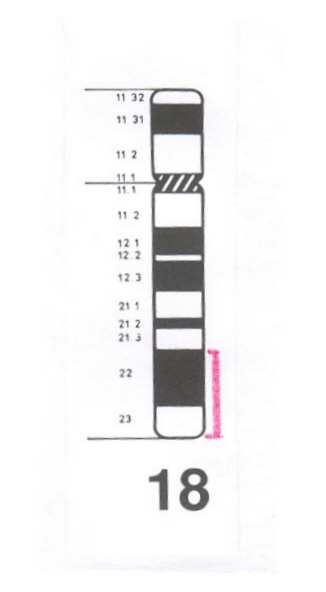 Hirschhornův syndrom 46,XX,del(4p)