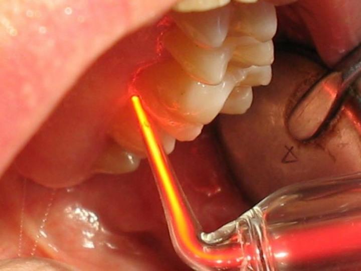 parodontálního abscesu, kde po třetí až páté aplikaci nacházíme klinicky