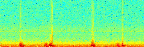 Frequency Mitrální stenóza.5 -.5-1.2.4.6.8 1 1.2 1.4 1.6 1.