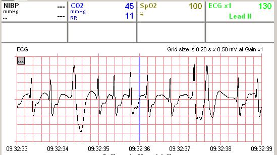 9:32:33 Obrázek 8 Fibrilace síní a komorové extrasystoly RR 11/min PETCO2 45 mmhg SpO2 100% Stav pacienta stabilizován Závěr: Kazuistika názorně ukazuje na digitálním záznamu vliv kvality cirkulace